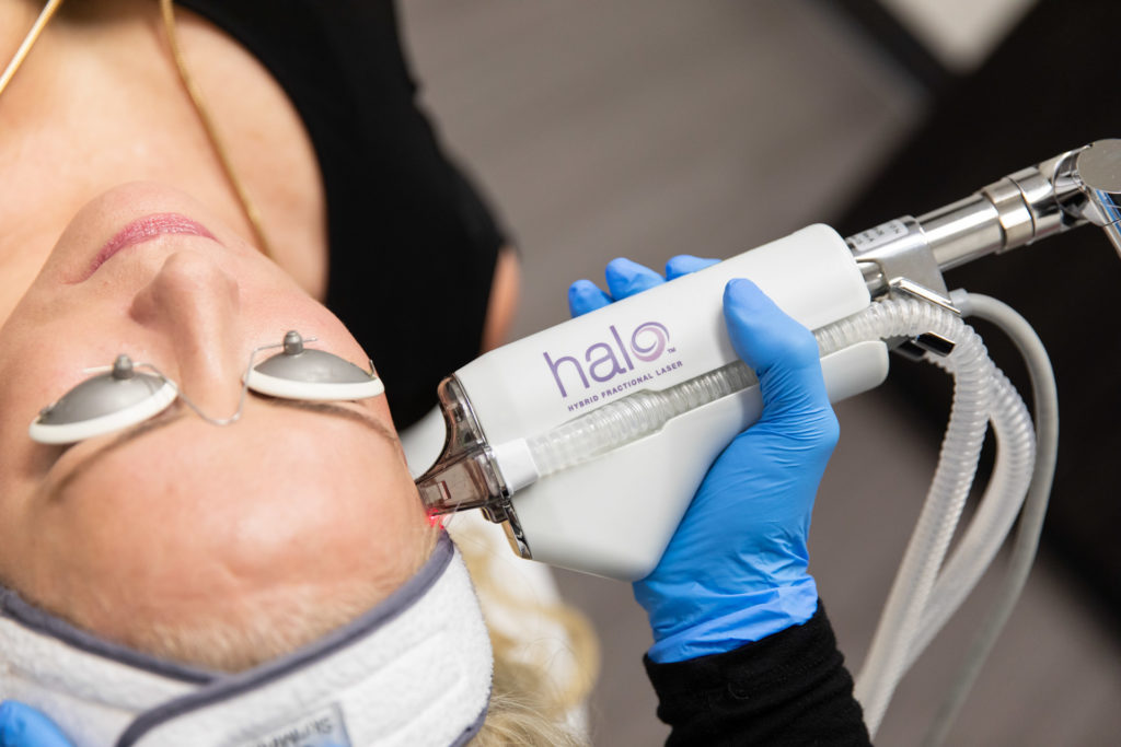 Halo hybrid fractional laser handpiece being used during a facial resurfacing treatment