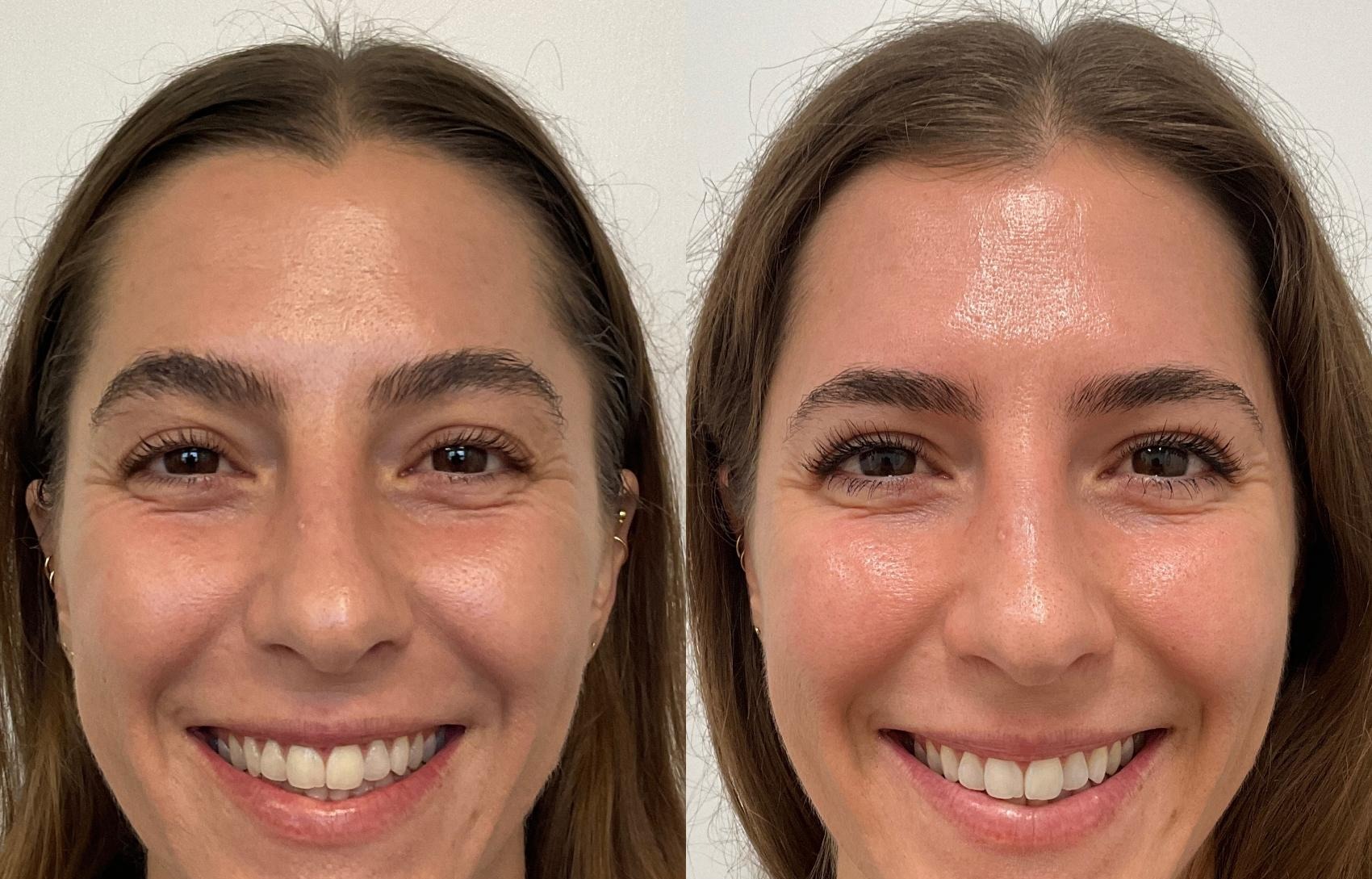 Before and after Halo hybrid fractional laser resurfacing showing clearer, more even skin tone and refined texture