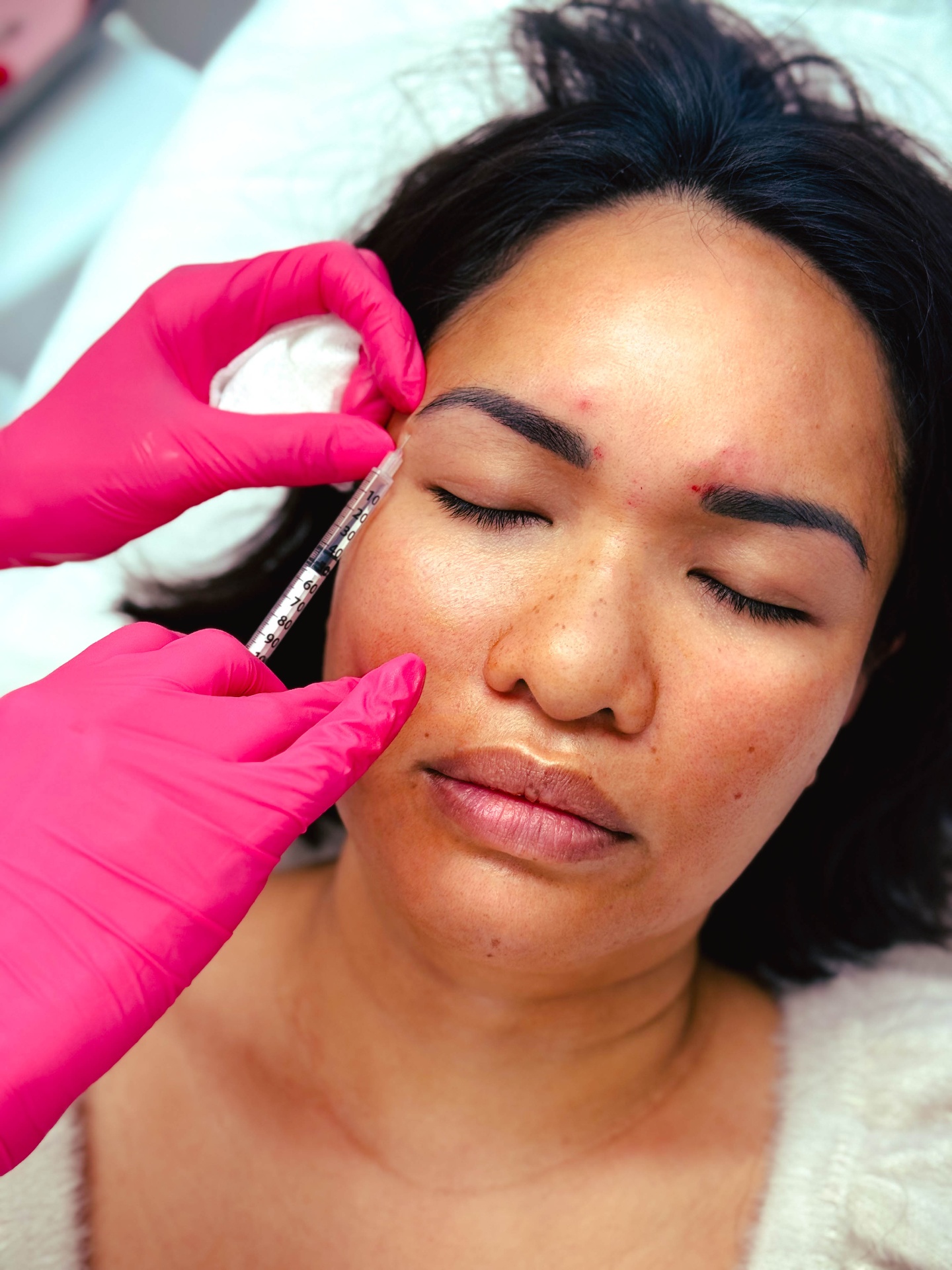 Medical dermatology cortisone injection treatment at La Jolla Laser Derm