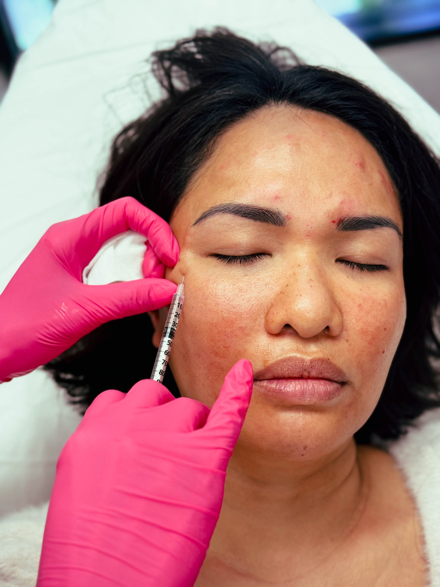 Dermal filler treatment for facial balancing at La Jolla Laser Derm