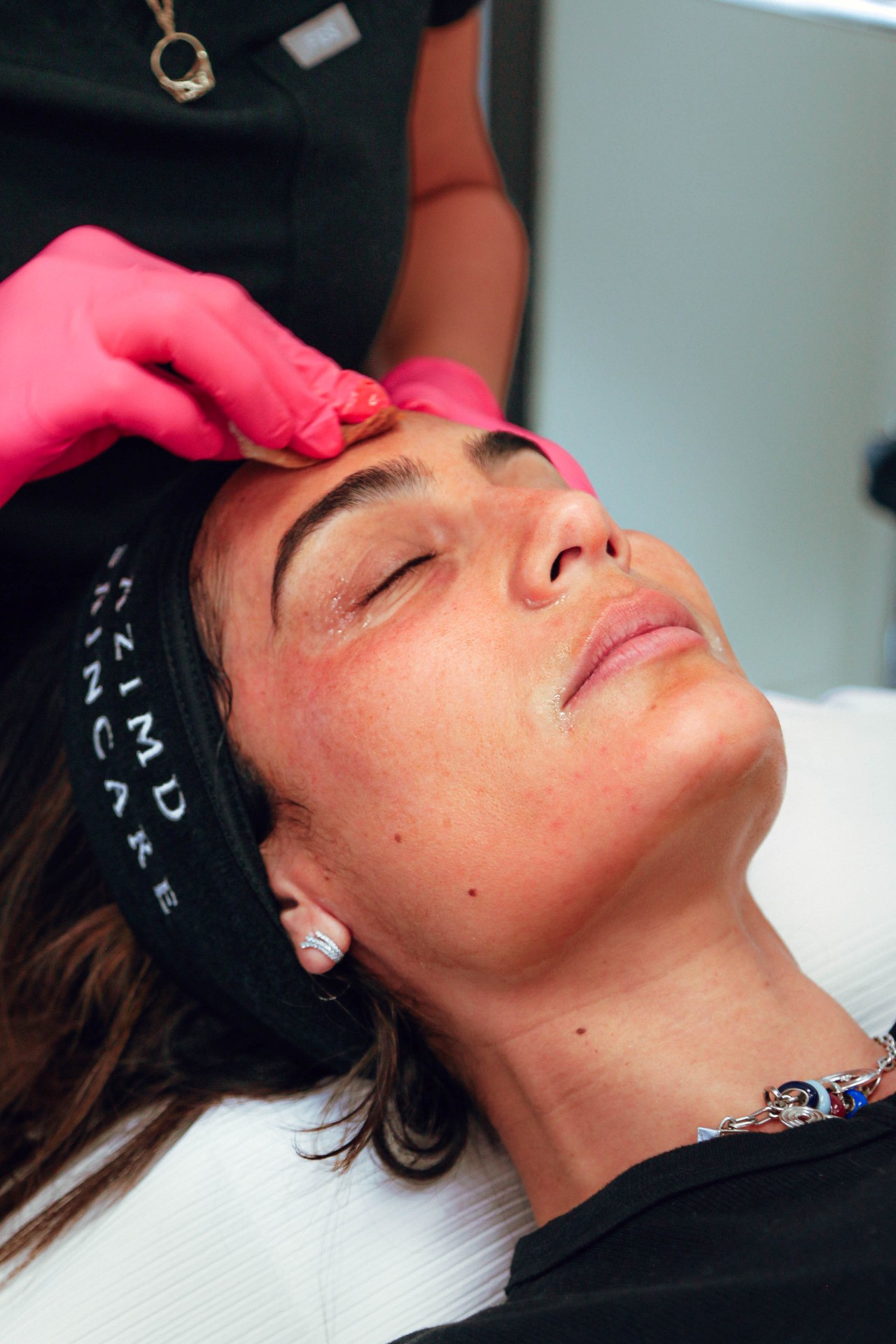 Chemical peel treatment for skin rejuvenation at La Jolla Laser Derm