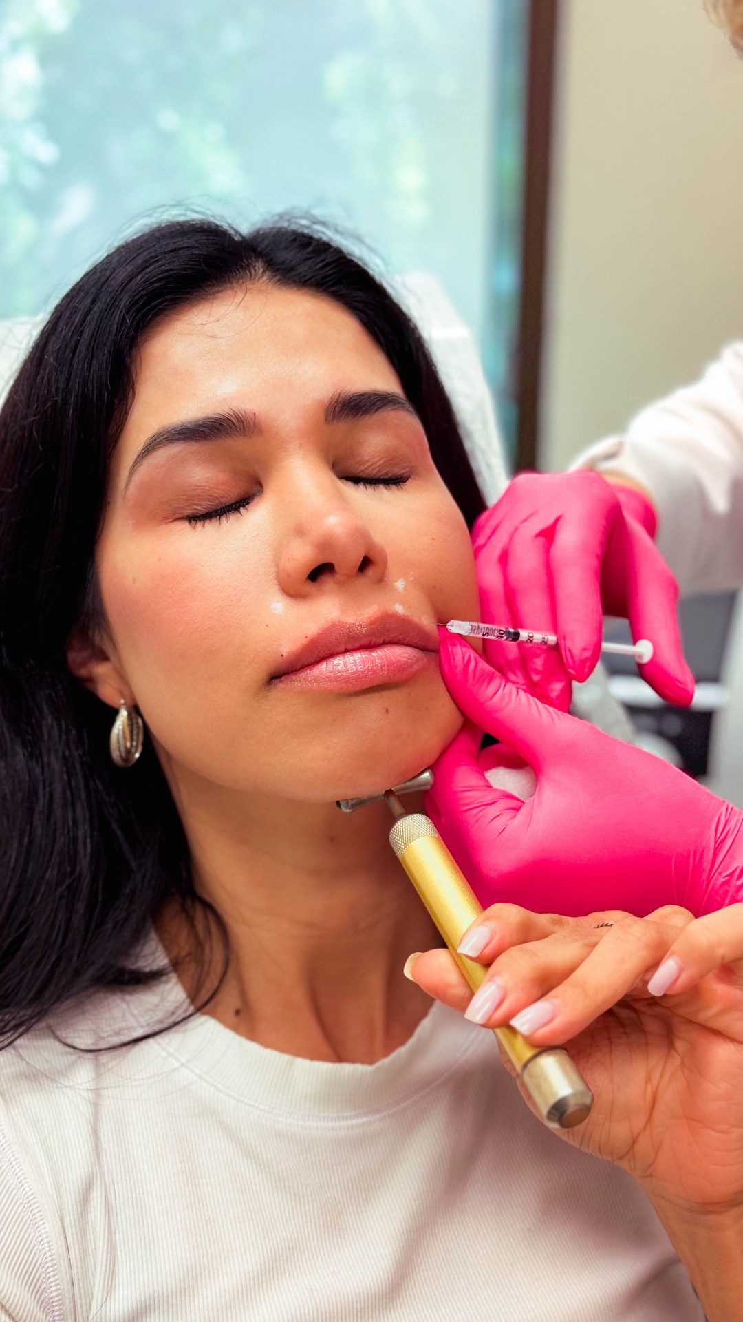 Dr. Shirazi performing precision lip filler injection on a female patient in La Jolla
