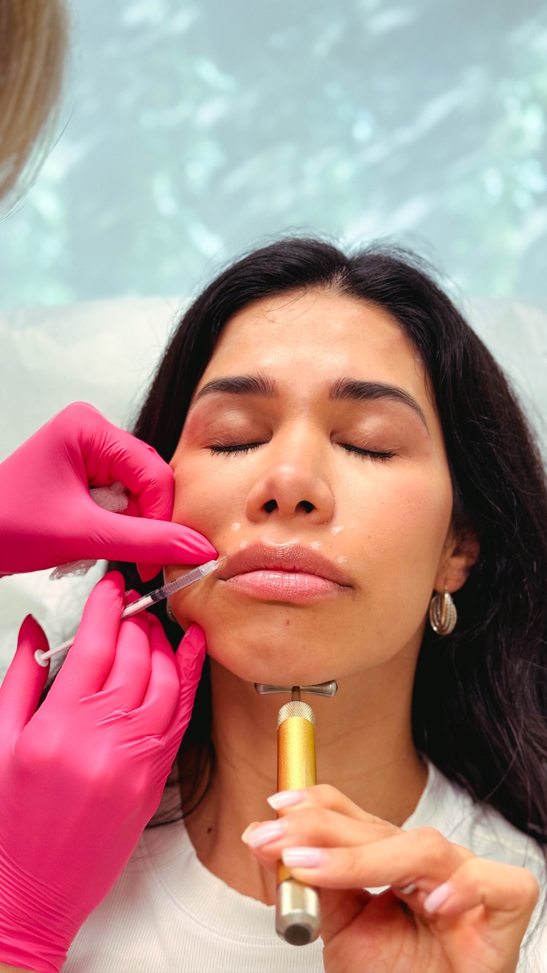 Precision lip filler treatment by Dr. Shirazi in La Jolla, CA