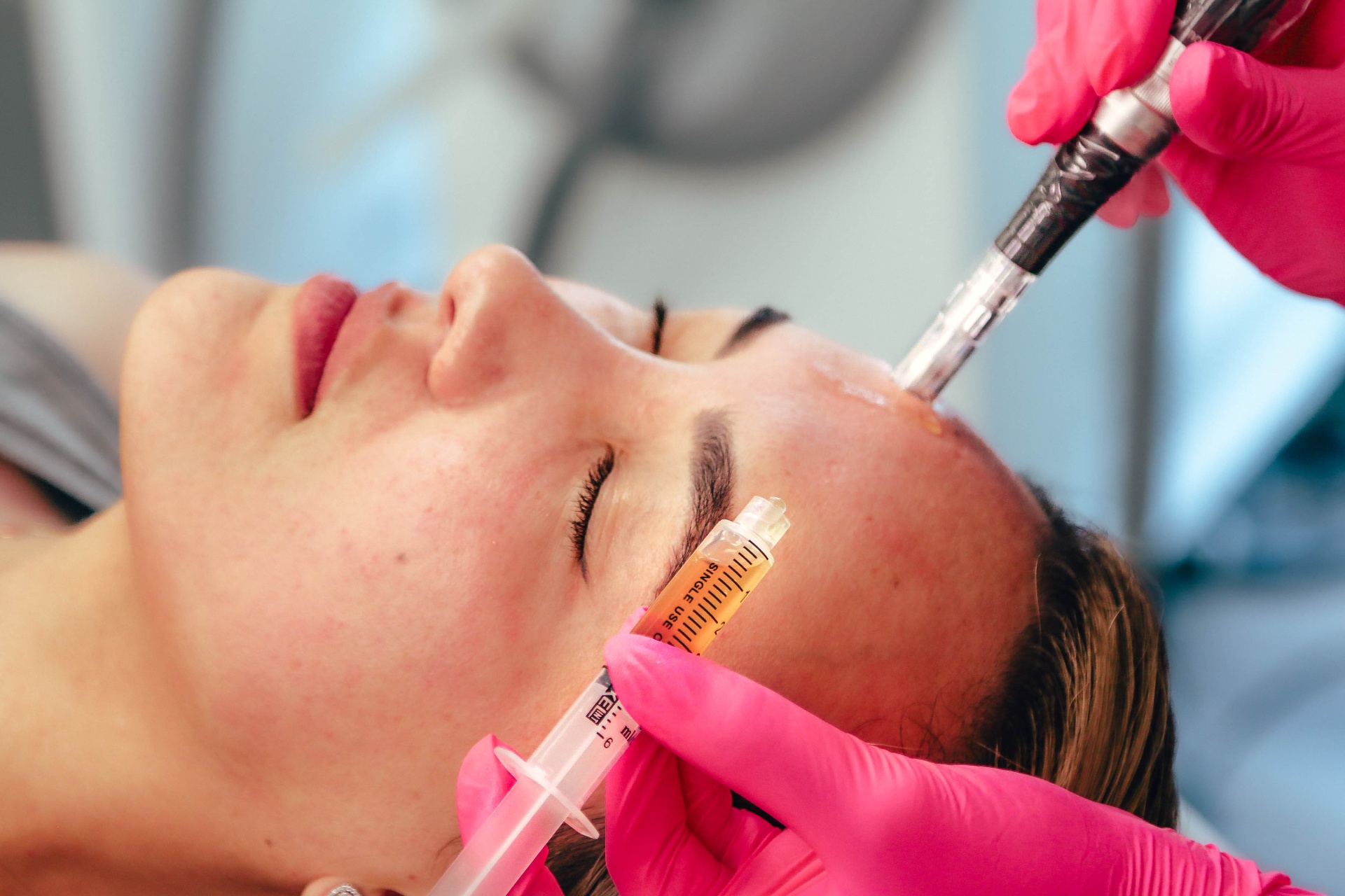 PRP microneedling treatment in progress at La Jolla Laser Derm